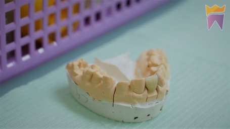 Имплантация зубов на четырех имплантах All-on-4