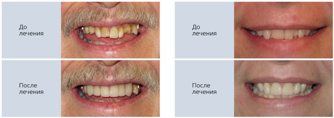 Металлокерамика стоматология Ульяновск
